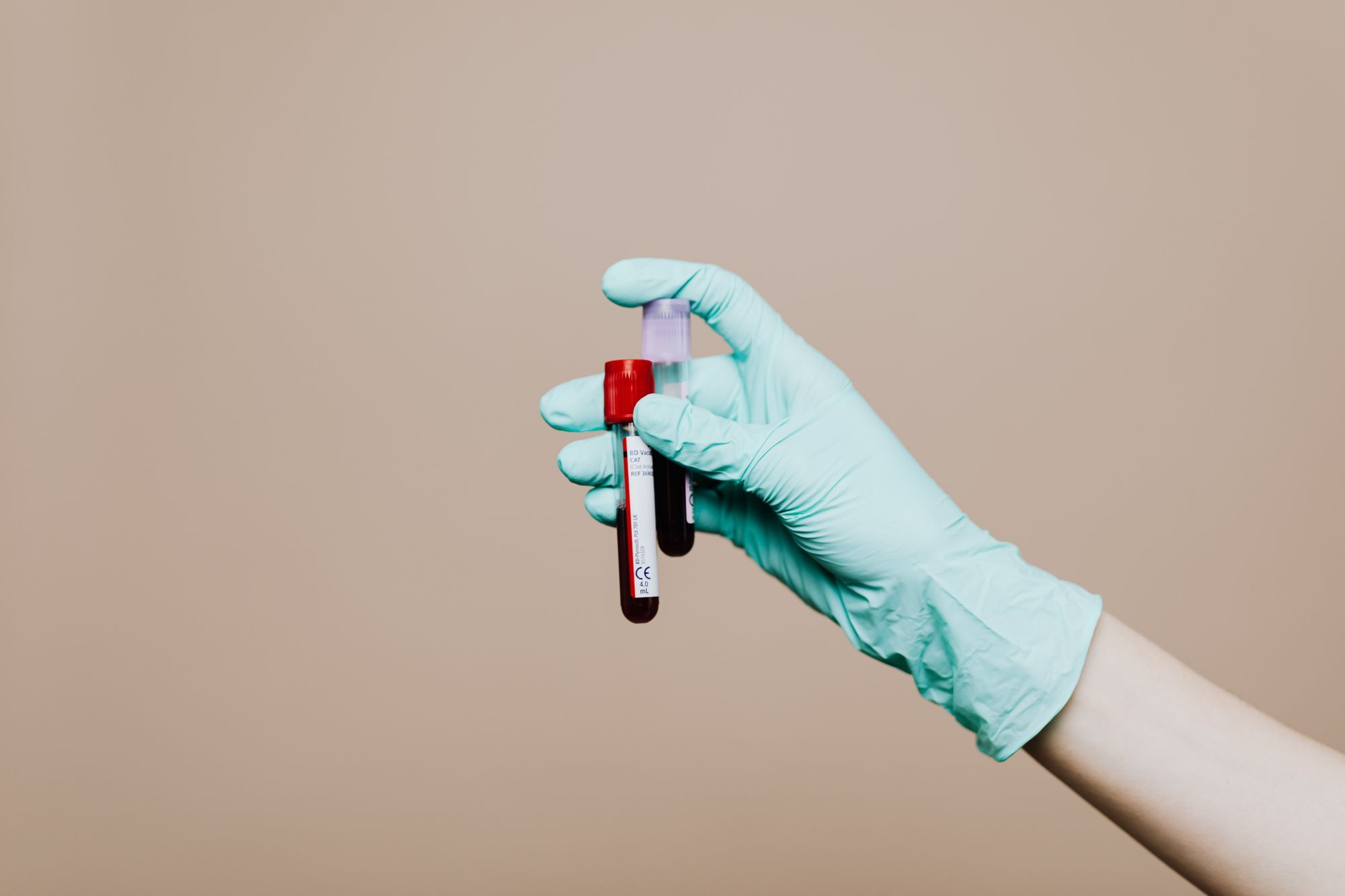 Test na BRCA gene radi se iz uzorka krvi i pokazuje da li osoba nosi naslednu mutaciju 