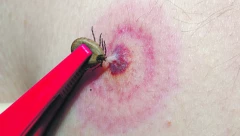 Kako pravilno ukloniti krpelja, a da delovi parazita ne ostanu u našem telu? Važna pravila