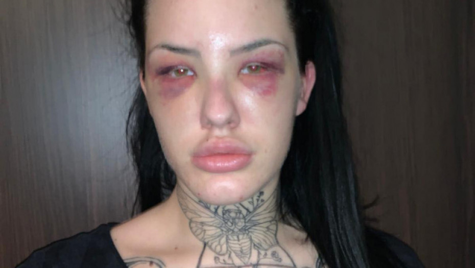 PREBIJENA NA MRTVO IME Ovako izgleda drugarica Tijane Ajfon nakon što ju je dečko pretukao, nije za one slabog srca!