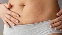 Pomaže ili ne? Puževa sluz za strije