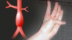DOKTORI APELUJU! TEST SA PALCEM DAJE INFORMACIJE KAO SKENER: Za ovu podmuklu i smrtonosnu bolest, nekoliko sekundi pravi razliku između života i smrti