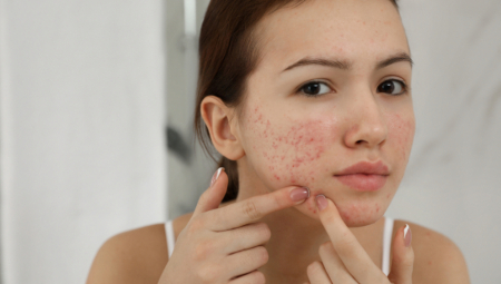 KAKO PRAVILNO ISTISNUTI BUBULJICU? Dermatolog vas moli da se pridržavate ovih pravila