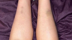 Postoji objašnjenje: Zbog čega se javljaju modrice po telu, a nije udarac