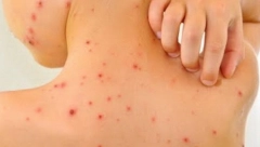 OVO SU SIMPTOMI VARIČELA Deca to ne mogu da sakriju, obratite pažnju na ove 3 STVARI!