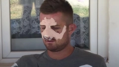 NIKOLA JE OPERISAN I PUŠTEN KUĆI Mladić kojeg su Albanci mučki pretukli se uspešno oporavlja