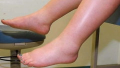 RIZIK OD TROMBOFILIJE SE POVEĆAVA S GODINAMA: Stanje može biti urođeno, pojavljuje se i kod trudinca, a ovo su najčešći simptomi