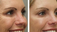 KOŠTA 50 DINARA, A IMA EFEKAT BOTOKSA Posle 12 dana ova maska briše bore i vraća mladelački sjaj