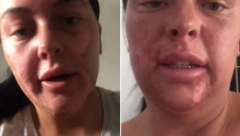 ZBOG JEDNE GREŠKE U KUHINJI HITNO ZAVRŠILA U BOLNICI Žena je dobila jezive opekotine po celom licu, a sada se gorko kaje! (VIDEO)
