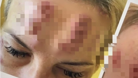 KINESKI BOTOKS STIGAO U SRBIJU: Doktorka upozorila o posledicama koje su fatalne (UZNEMIRUJUĆE FOTOGRAFIJE)