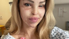 SILOVAO JE OSAM SATI, PA POLIO KISELINOM Poznata manekenka je imala 400 operacija, lice joj bilo UNIŠTENO, a danas je NEPREPOZNATLJIVA
