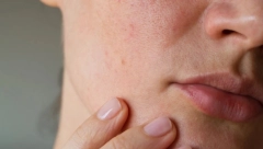 SADA JE NAJVAŽNIJA HIDRATACIJA Pet saveta dermatologa za savršenu negu lica tokom zime