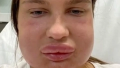 OD REAKCIJE JOJ JE OTEKLA CELA GLAVA: Otišla je na kozmetički tretman, a završila u bolnici, ovo je ono što svaka žena treba da zna