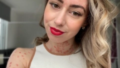 DA LI JE PSORIJAZA PRENOSNA?