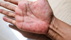 OVA BOLEST SE ŠIRI KAO EPIDEMIJA Gluten uništava štitnu žlezdu, a ovo su znaci da vam škodi