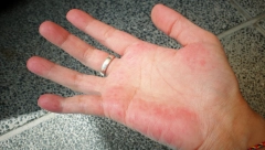 POGLEDAJTE DLAN Pregibi kože kriju znak da su srce i krvni sudovi ugroženi