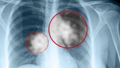 PULMOLOG UKCS: ZBOG OVE TRI STVARI SVE VIŠE LJUDI U SRBIJI BOLUJE OD ASTME! Prekinite sa ovim odmah!