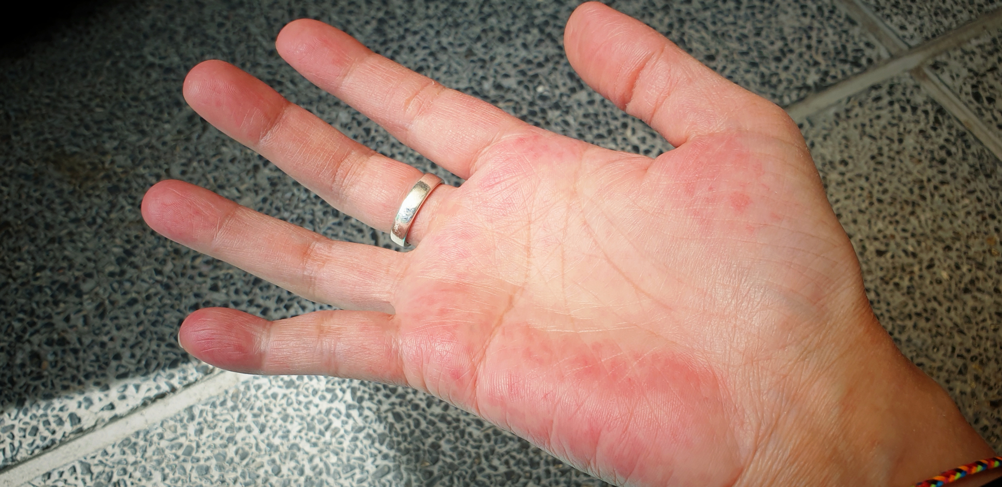 AKO IMATE OVU PROMENU NA DLANU, MORATE ODMAH KOD LEKARA To je pokazatelj da vam je zdravlje narušeno