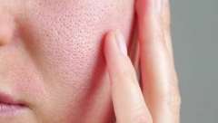 GODINAMA SE LEČILA OD EKCEMA Fleka na licu počela je da krvari, a onda je saznala strašnu dijagnozu