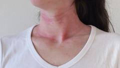 NAKON KUPANJA IMATE CRVENE PEČATE PO TELU? Evo šta može biti razlog, jedan je prilično zabrinjavajući