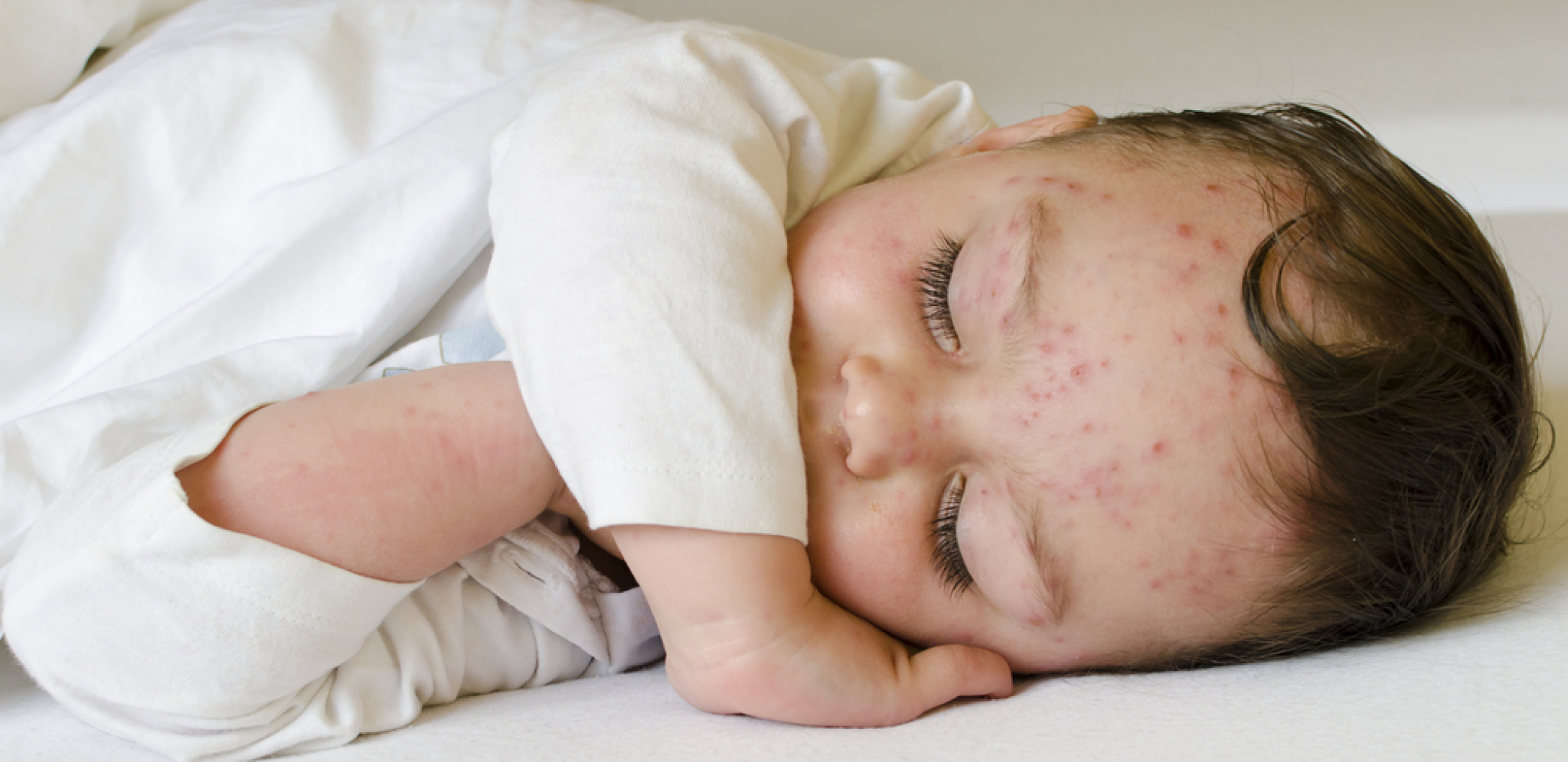 RODITELJI, OBRATITE PAŽNJU NAREDNIH DANA Hara epidemija boginja