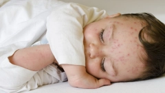 RODITELJI, OBRATITE PAŽNJU NAREDNIH DANA Hara epidemija boginja