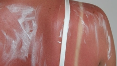 PREKOMERNO IZLAGANJE SUNCU UZROKUJE OŠTEĆENJA NA KOŽI: Evo kako da je tretirate i vratite joj hidriranost i sjaj