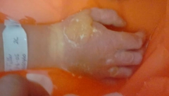 DEVOJČICA (4) ZADOBILA UŽASNE OPEKOTINE: Dodirnula je ovu opasnu biljku koja izgleda kao korov i raste u dvorištima