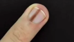 NIKADA NE IGNORIŠITE OVE PROMENE NA NOKTIMA Neke izgledaju bezazleno, a mnogu da budu da budu simptom smrtonosne bolesti