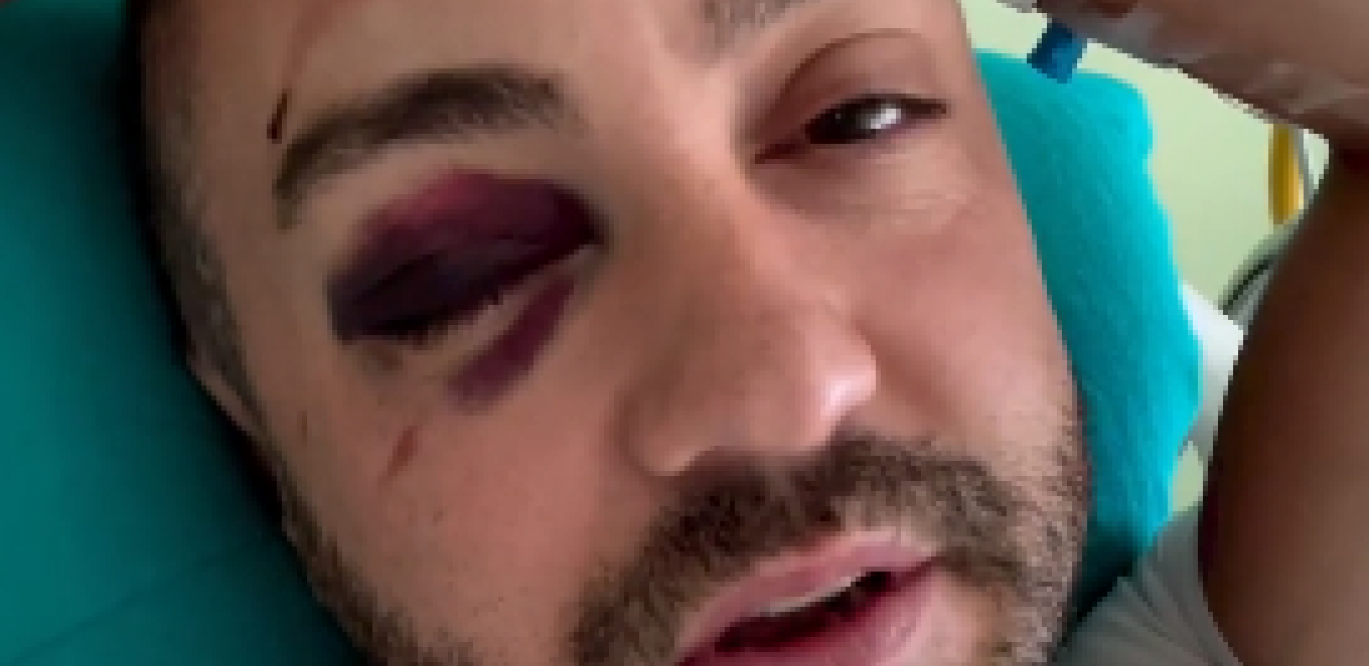 SVE JE SMRSKANO, MORA OPERACIJA Teško povređen crnogorski komičar koji je oduševio Novaka Đokovića: Pukla mu čeona kost, otvaraju ga (VIDEO)