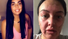 SPALILA LICE ZBOG TRIKA NA DRUŠTVENIM MREŽAMA Mesecima se oporavlja, upozorila sve devojke da se paze!