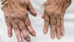 GLAVNI UZROK REUME NALAZI SE U VAŠEM FRIŽIDERU: Jedemo je svaki dan, a sadrži opasnu bakteriju koja ubrzava ovu bolest!