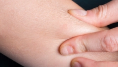 SVAKA 10. ŽENA U SRBIJI PATI OD OVE AUTOIMUNE BOLESTI Rani simptomi se mogu videti na koži, ako ih primetite javite se odmah lekaru