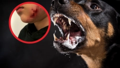 DEVOJČICU (7) RASTRGAO ROTVAJLER: Ostavio joj je duboke rane na licu, a preživela je zahvaljujući kapuljači na jakni (FOTO)