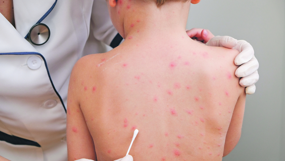 RODITELJI BRINU DA LI JE PRED NAMA JOŠ JEDNA EPIDEMIJA Skoro 2.000 dece obolelo od početka godine