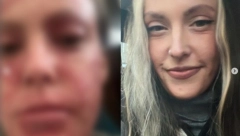 PRESTALA DA KORISTI KREME ZA EKCEME I LICE JOJ SE UNIŠTILO! Devojka pokazala pakao kroz koji prolazi - ljuštenje kože, bolovi... (FOTO)