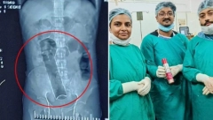 20 DANA NIJE VRŠIO NUŽDU!: Imao je nesnosne bolove i primljen je u hitnu, a hirurzi su se frapirali kada su videli šta se zaglavilo u analnom otvoru!