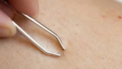 ČETIRI MESECA BIO U KOMI, A ŠEST SATI JE TRAJALA OPERACIJA: Urasla dlaka ga umalo koštala života, a evo kada je smrtonosna