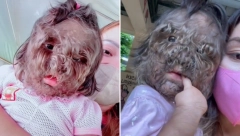 SESTRA NA POROĐAJU SE ONESVESTILA KADA JE UGLEDALA: Devojčica sa sindromom vukodlaka je jedna u milion