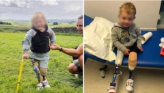 DEČAK SE U VRTIĆU NIJE OSEĆAO DOBRO: Ličilo je na običnu prehladu, a onda su mu odsekli obe noge