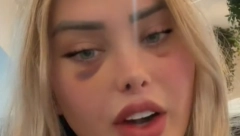 ŠOK! POTRESNA ISPOVEST TIKTOKERKE Nakon estetske operacije napukla joj je glava (FOTO)