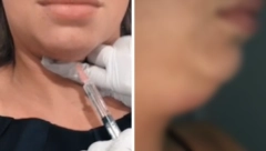 DENIZ POSLE ZAHVATA ESTETSKE MEDICINE IZGLEDA "KAO ŽABA" Dečko se uplašio kada me je video