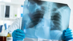 SRBIJOM HARA OPAKI VIRUS, A NIJE KORONA: Čuveni pulmolog otkrio najbolji lek protiv upale pluća i upornog kašlja