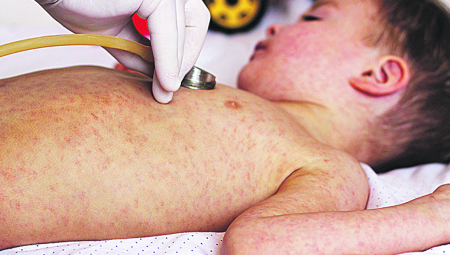 BOGINJE SE ŠIRE, LEKARI U PANICI Srbija na pragu ogromne zaraze, deca ugrožena, roditelji se i dalje igraju životima: Zatvor za antivaksere!