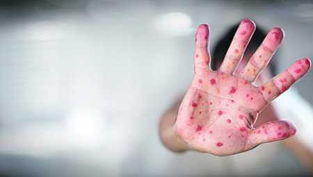 U BUDVI PROGLAŠENA EPIDEMIJA MORBILA!