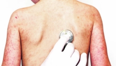 RASTE BROJ OBOLELIH OD MORBILA Potvrdio Batut: Malim boginjama zaraženo 26 osoba