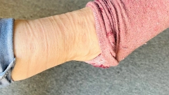 OSTAJU VAM TRAGOVI NA NOGAMA KADA SKINETE ČARAPE? Evo na koje bolesti može da ukaže ova pojava, nikako je ne ignorišite