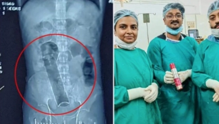 DVADESET DANA NIJE VRŠIO NUŽDU: Primljen je u bolnicu, a hirurzi su se frapirali kad su ga operisali(FOTO)