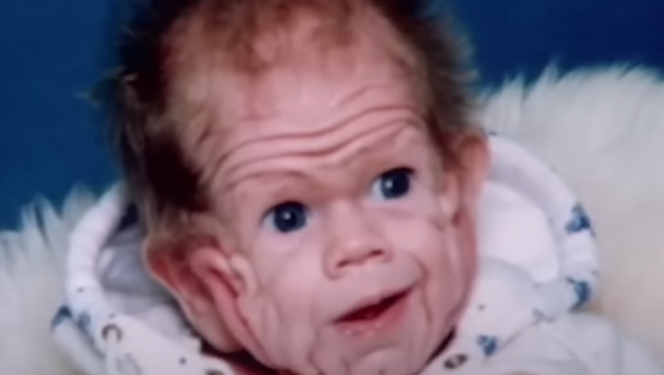 PRVI NA SVETU JE ROĐEN SA VIŠKOM KOŽE Doktori se šokirali kada su ga ugledali, a evo kako on danas izgleda (FOTO)