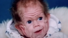 PRVI NA SVETU JE ROĐEN SA VIŠKOM KOŽE Doktori se šokirali kada su ga ugledali, a evo kako on danas izgleda (FOTO)