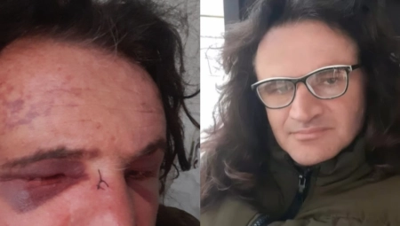 OVAKO IZGLEDA LEPI POSLE BRUTALNOG PREBIJANJA Pevaču cela glava u podlivima i modricama (VIDEO+FOTO)